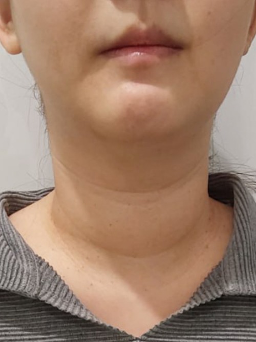After 이미지