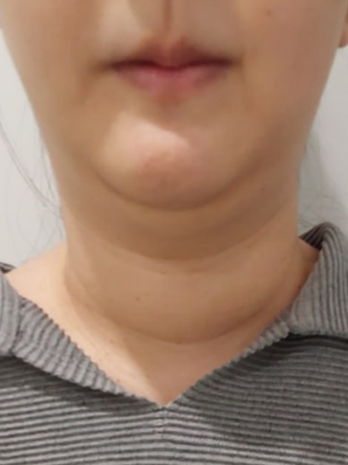 Before 이미지