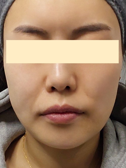 Before 이미지