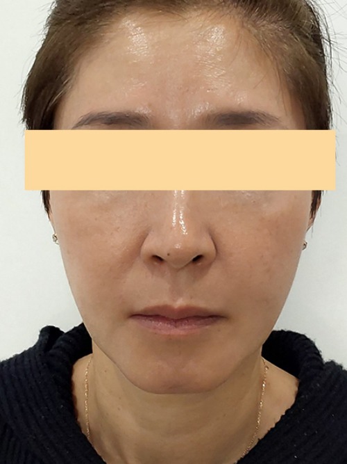 Before 이미지
