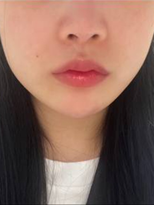 Before 이미지