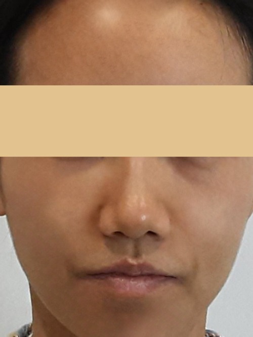 Before 이미지